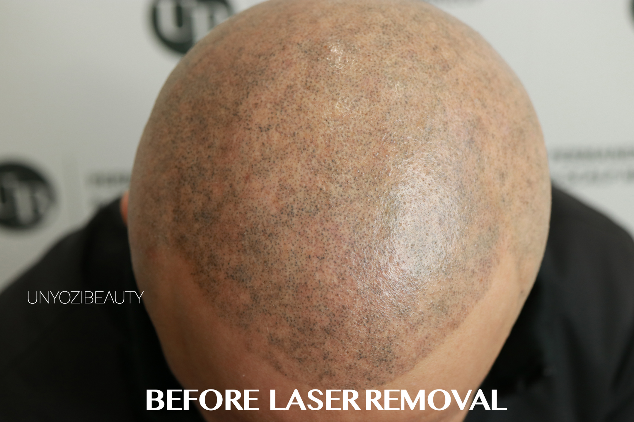 Fix bad hair transplant | Cosmedica - Dr. Levent Acar