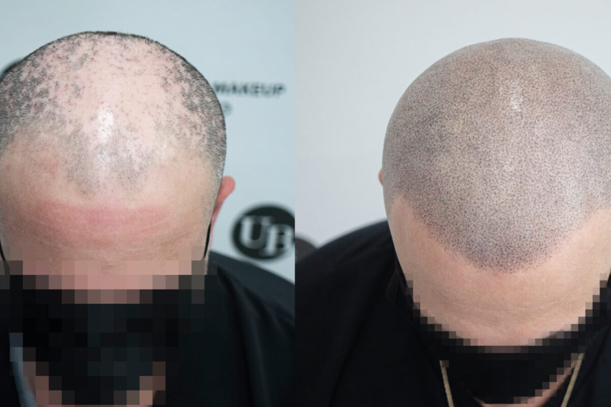 Alopecia-Scalp-Micropigmentation-Solutions