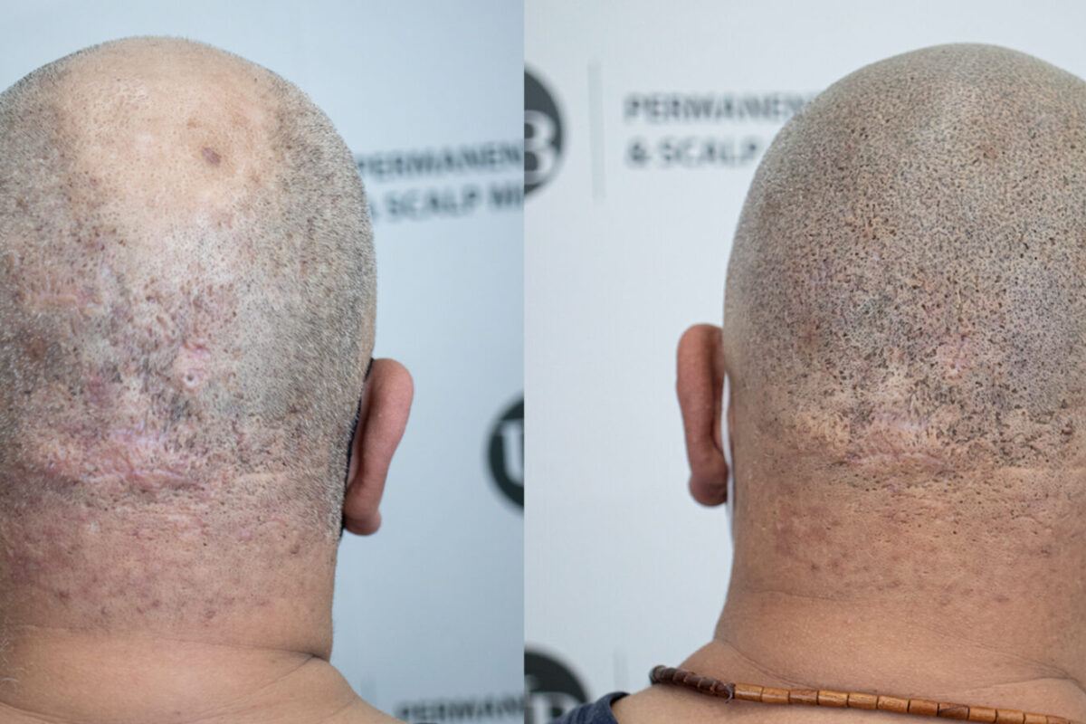 Amazing-Transformation-Scalp-Micropigmentation-Hairline-Tattoo-unyozibeauty