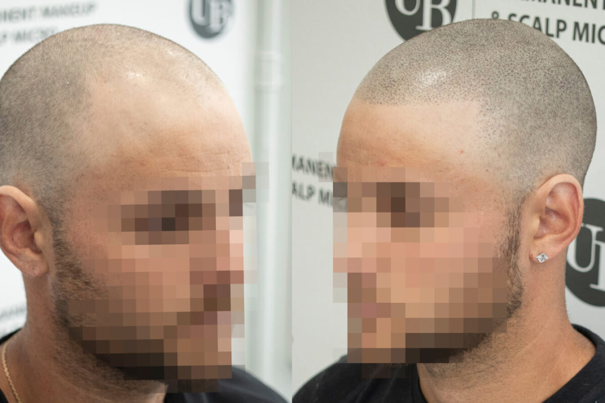 Baldness-solution-scalp-micropigmentation-unyozibeauty