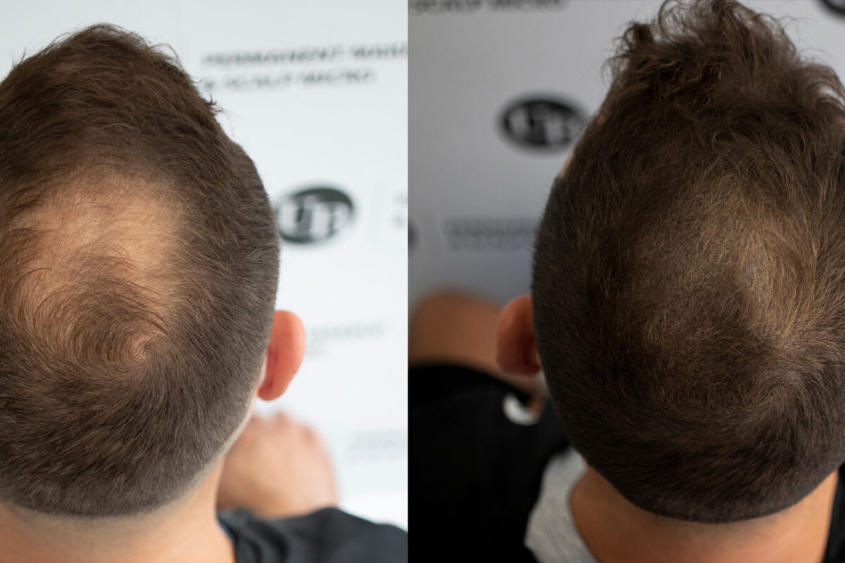 Hair-Density-Treatment-Hair-Loss-Unyozibeauty