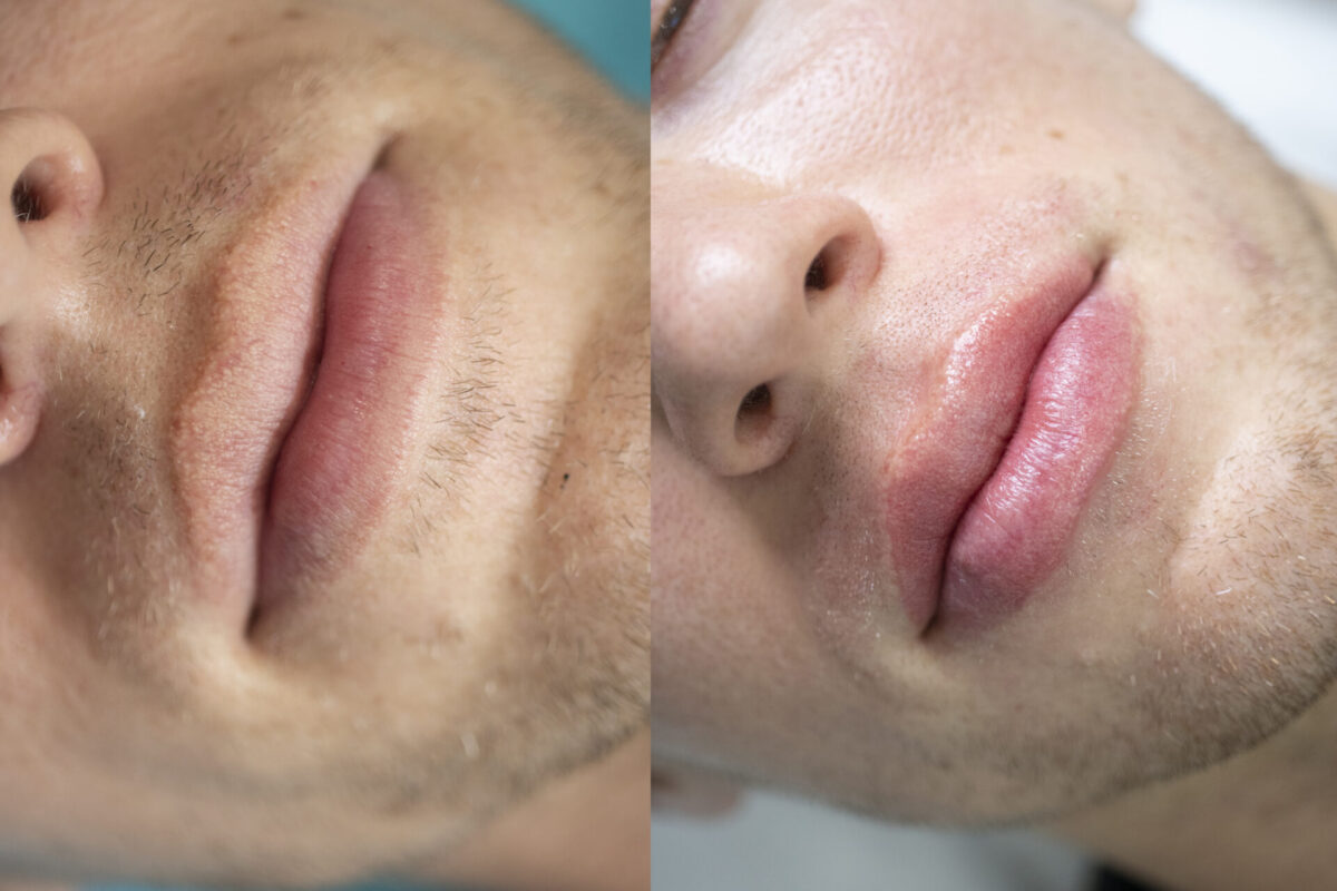 Men-Lip-Blush-Treatment-Unyozibeauty-Toronto