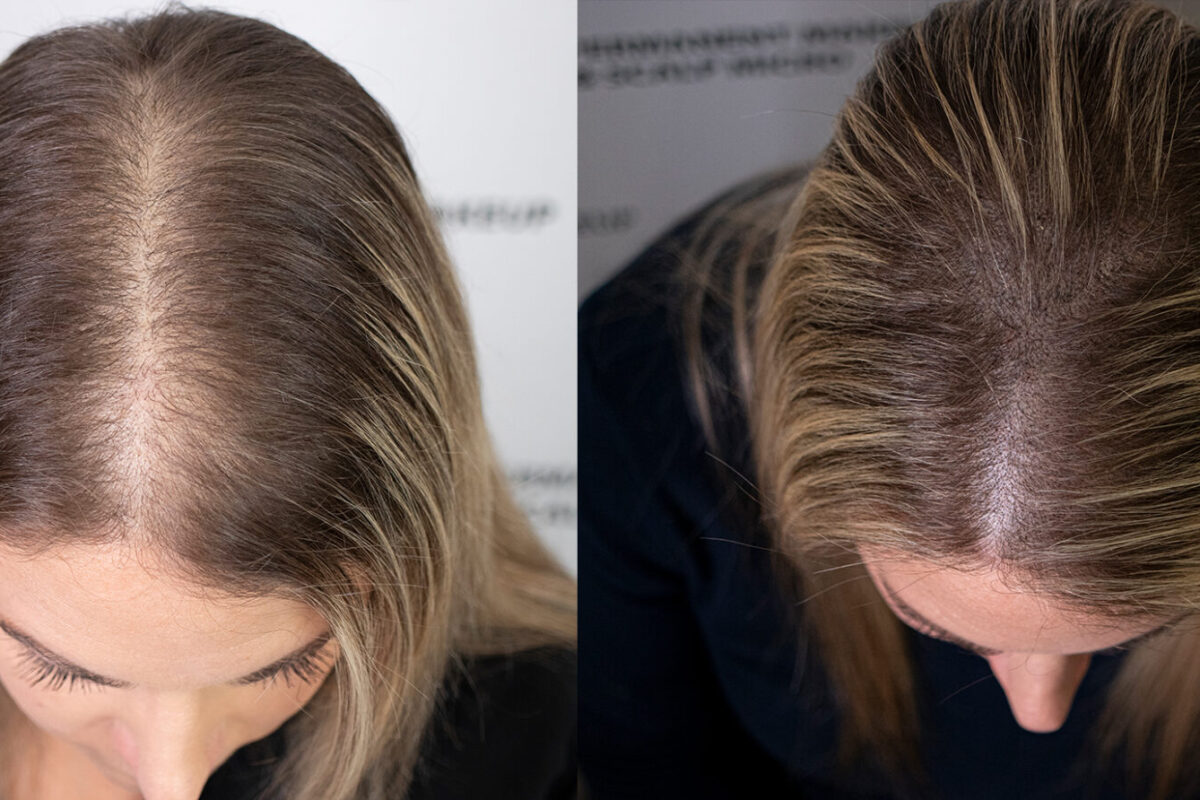 Scalp-Pigmentation-For-Female-Unyozibeauty