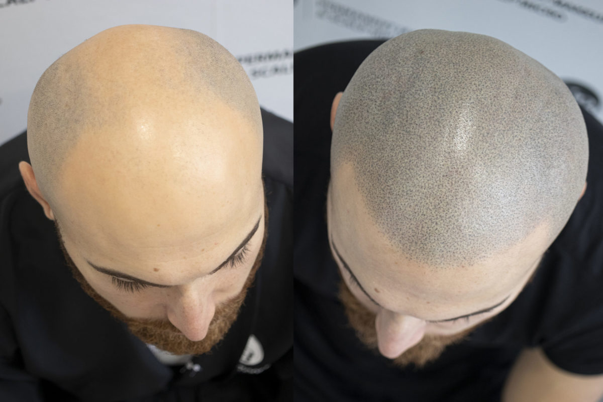 The-Most-Natural-Hairline-Scalp-Micropigmentation-Unyozibeauty