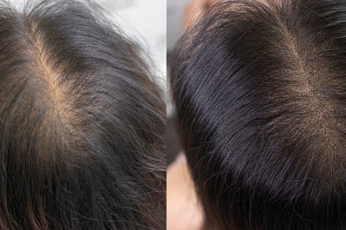 best-female-scalp-micropigmentation-toronto