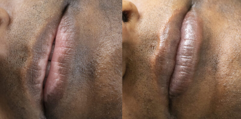 cometic-vitiligo-pigmentation