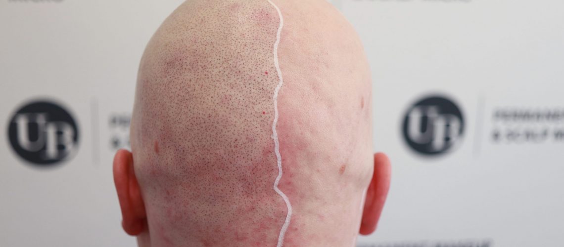 half-scalp-tattoo-alopecia