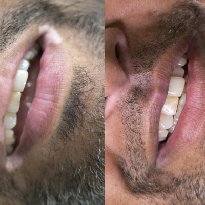 vitiligo-lip-pigmentation-unyozibeauty