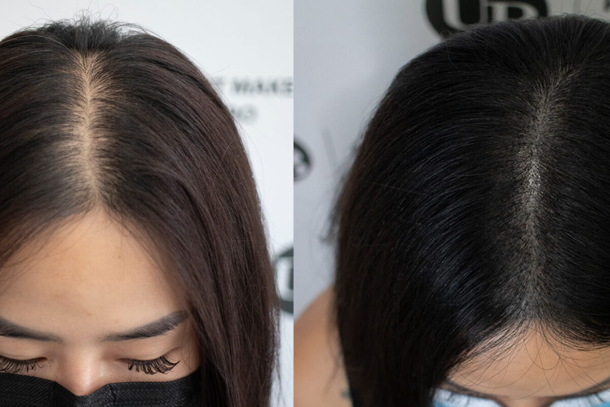 natural-scalp-micropigmentation-toronto-unyozibeauty
